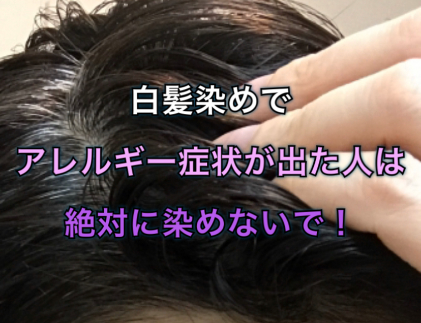 白髪染めでアレルギー症状が出た人は絶対に染めないで ノンジアミンカラーなど髪と頭皮の悩み解決を得意とする大阪寝屋川香里園の美容師あっくんのヘアケアブログ
