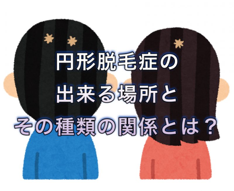 円形脱毛症の出来る場所とその種類の関係とは ノンジアミンカラーなど髪と頭皮の悩み解決を得意とする大阪寝屋川香里園の美容師あっくんのヘアケアブログ